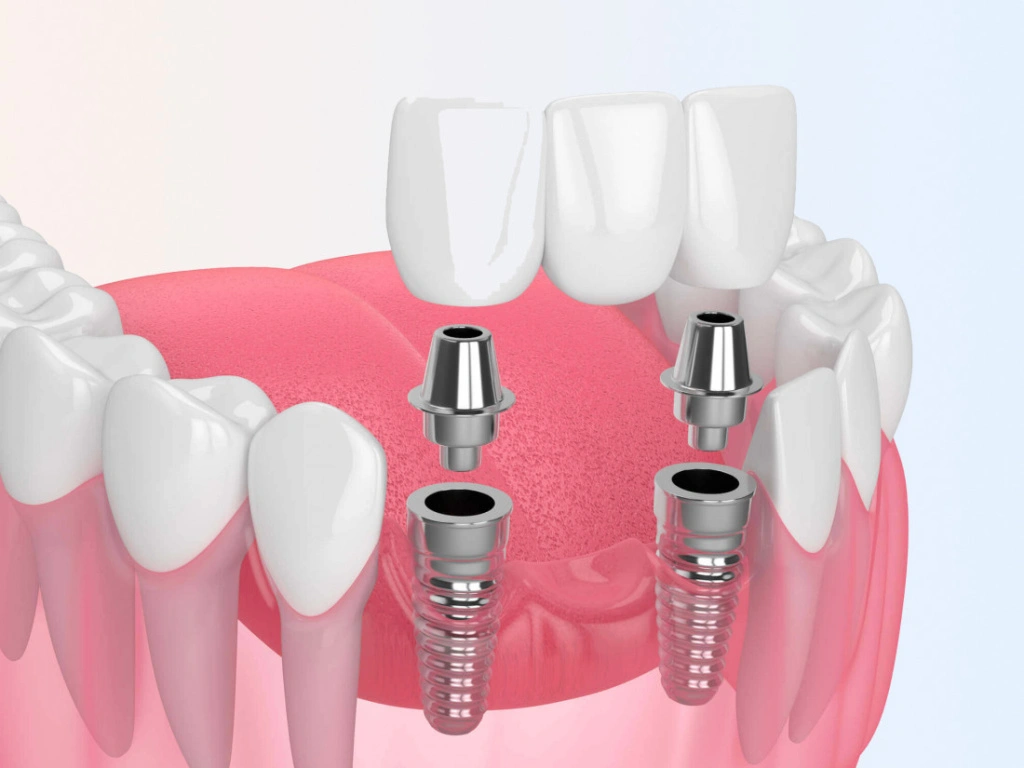импланты.jpg импланты.jpg