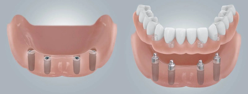 протезы на имплантах.jpg протезы на имплантах.jpg